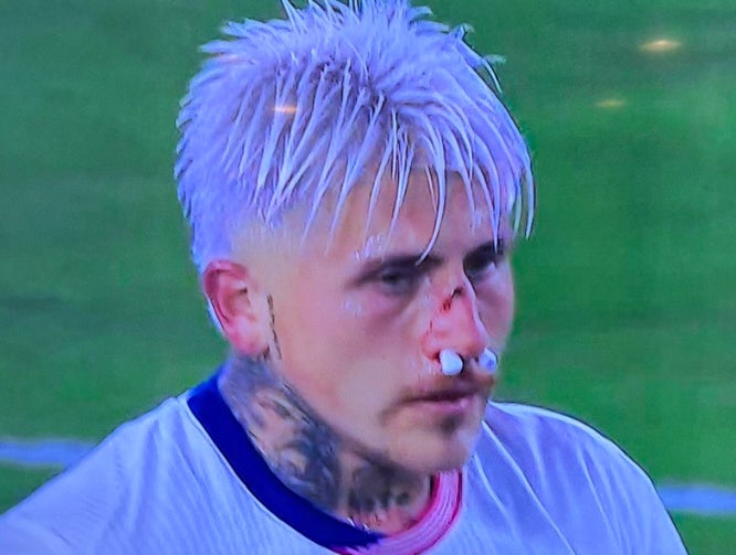 USMNT Player Breaks His Nose Mid-Game and Returns to Drop an Assist